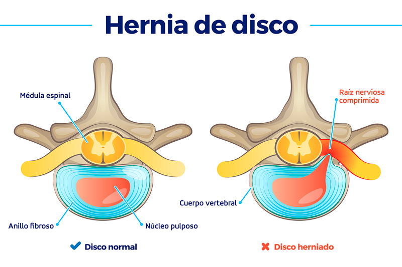 hernia de disco