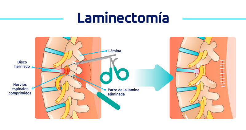 Cirugía de columna lumbar - Serie—Anatomía normal: MedlinePlus enciclopedia  médica
