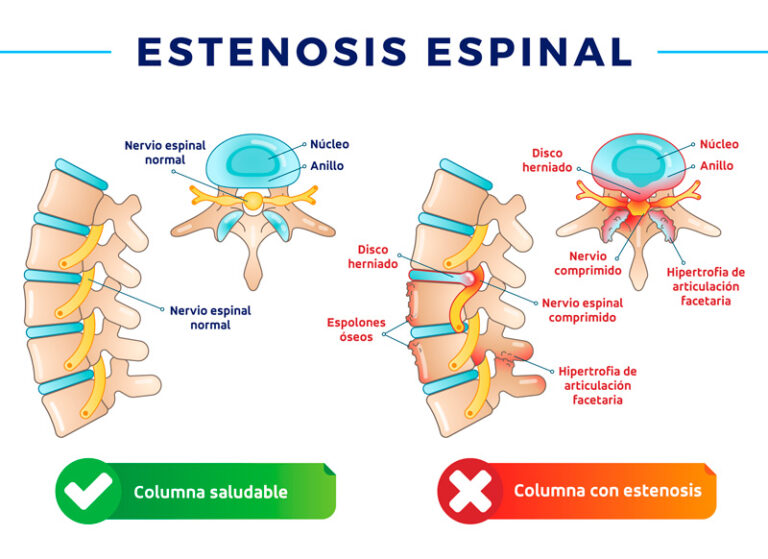 Estenosis Espinal Tipos Causas Factores De Riesgo Signos S Ntomas The