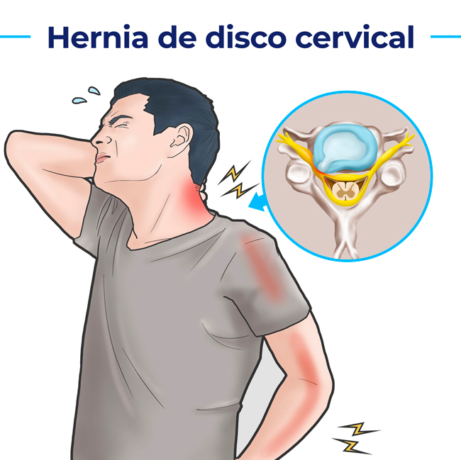 hernia de disco cervical