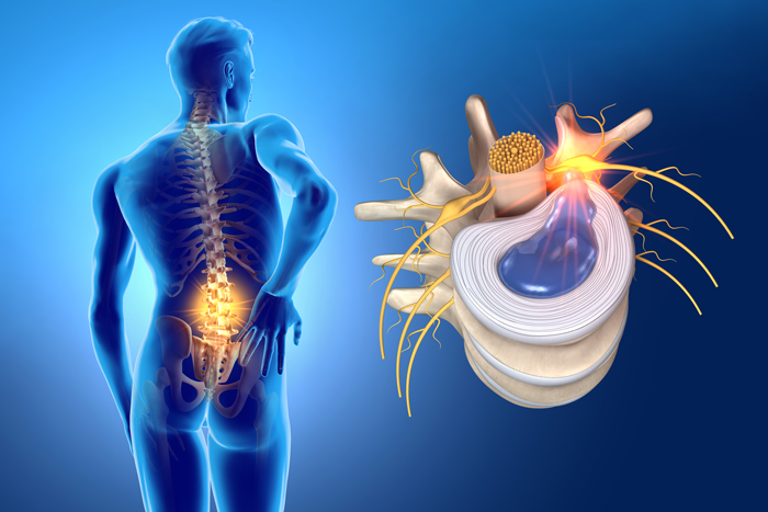 tratamiento no quirúrgico de hernia discal