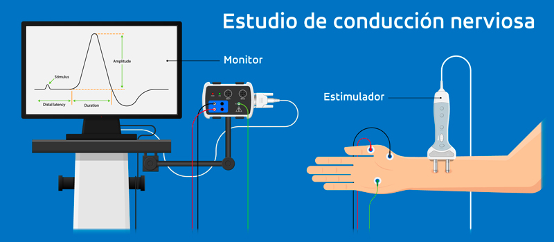 estudio de conducción nerviosa