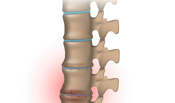 cómo fumar afecta la columna vertebral