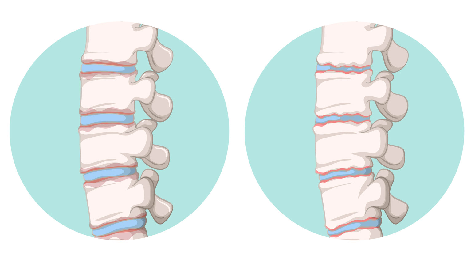 espondilitis anquilosante