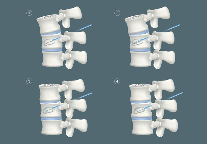 espondilitis anquilosante