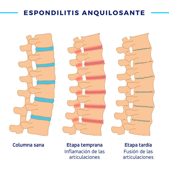 espondilitis anquilosante