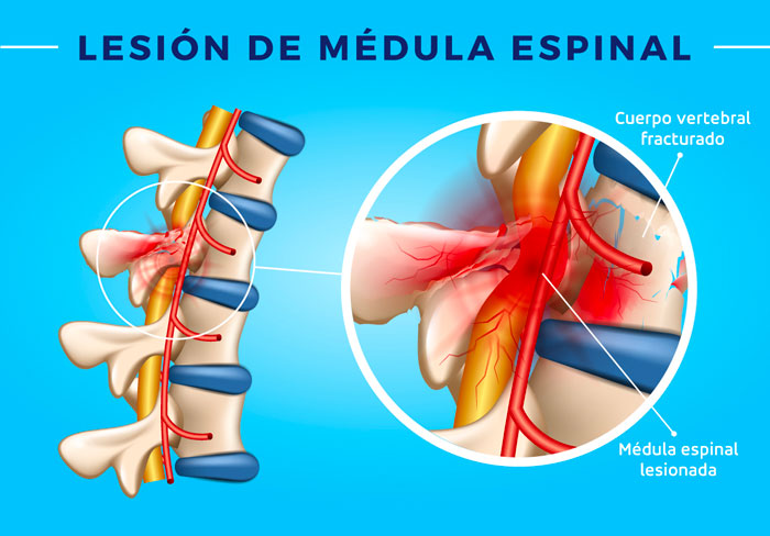 lesión de médula espinal
