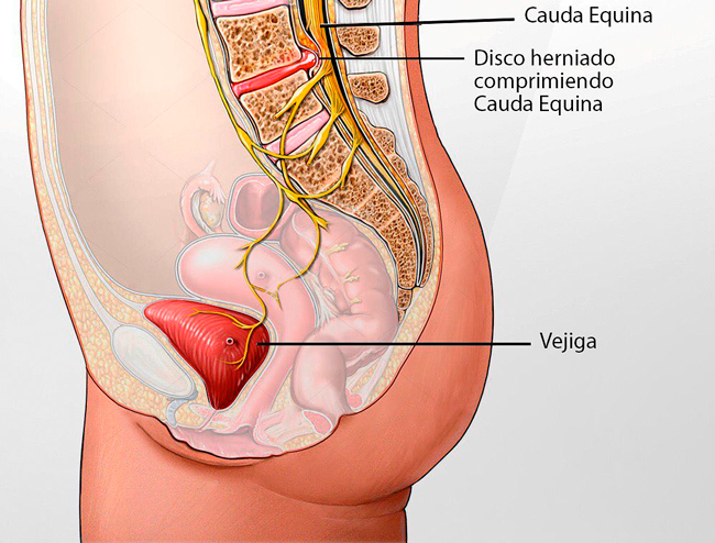 síndrome de cauda equina