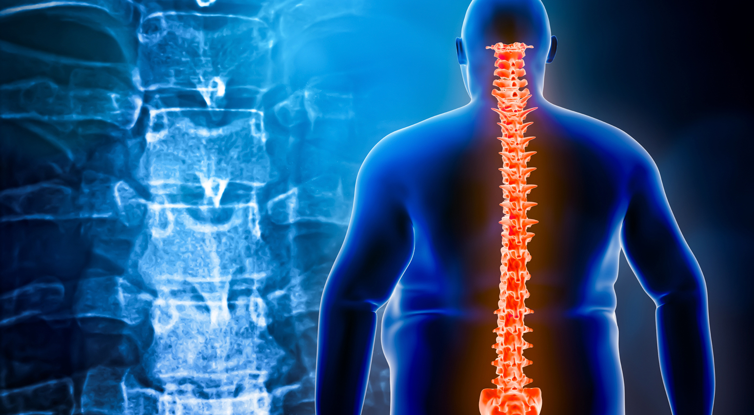 obesidad y dolor de espalda