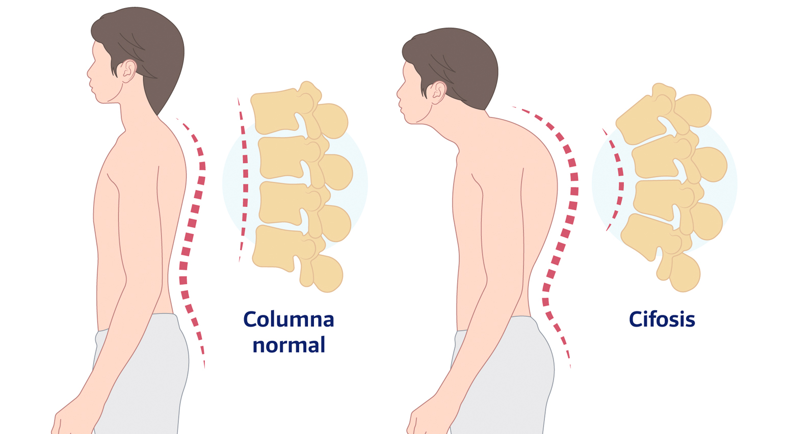 cifosis de Scheuermann