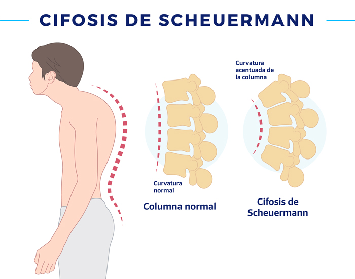 cifosis de Scheuermann