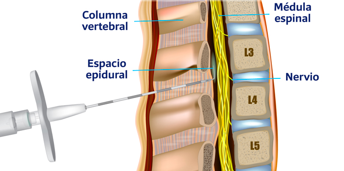 inyecciones epidurales