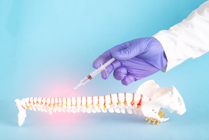 radiculopatía