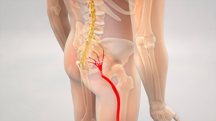 radiculopatía