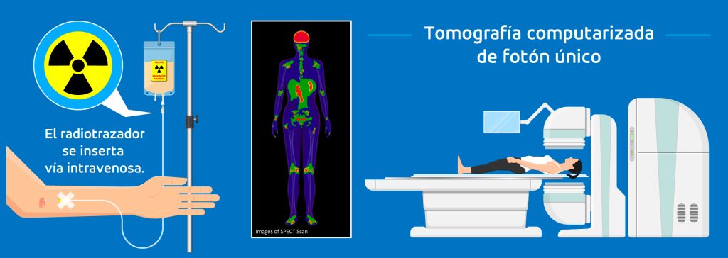 tomografía computarizada de fotón único